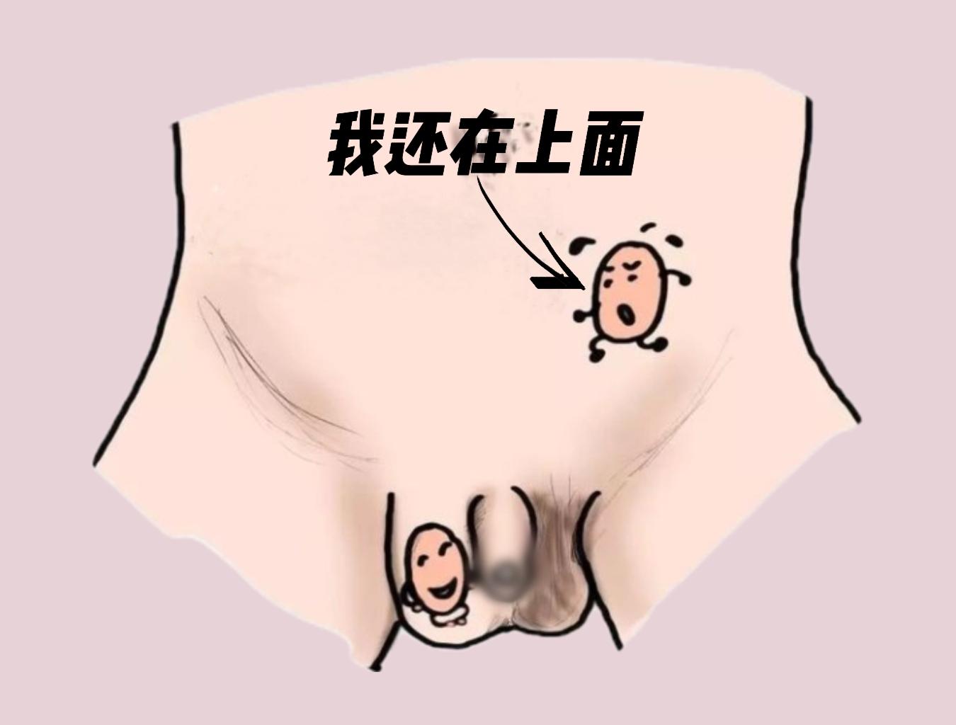男孩出生时,正常情况下左右阴囊内各有一个睾丸,如果出现睾丸下降不全
