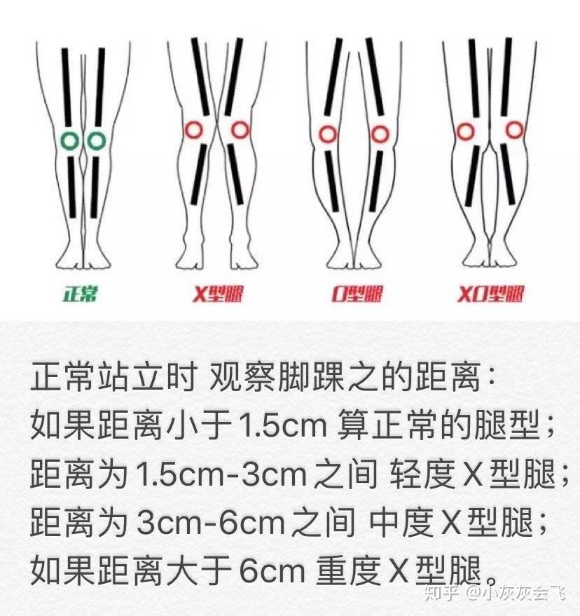 x型腿矫正方法图解图片