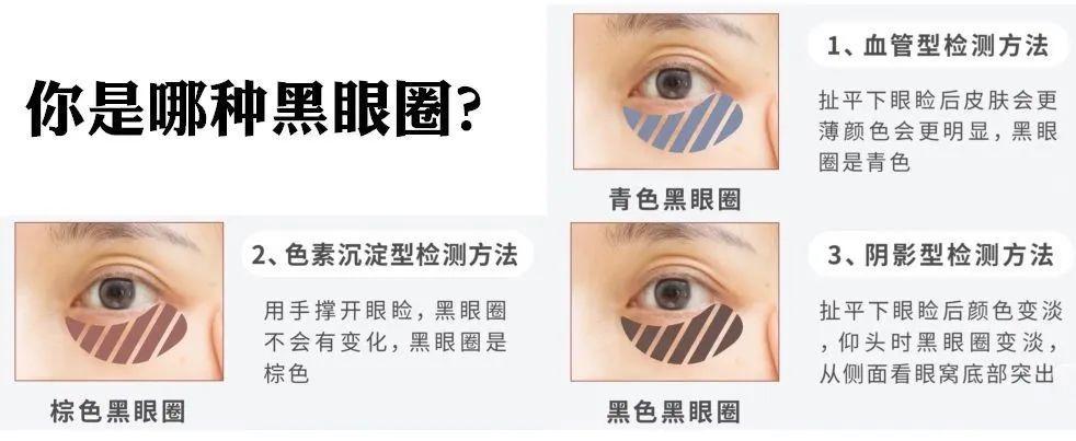 临床上利用伍德式灯及超声波仪等将黑眼圈分为色素型,血管型,结构型和