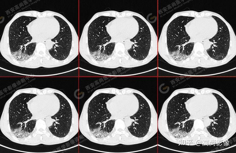 pet/ct病例—肺粘液腺癌,历经3年余终确诊【西安高尚医学影像诊断中心