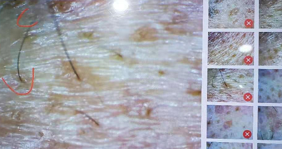 痘痘里面的毛囊虫 是怎么被检测出来的? - 知乎