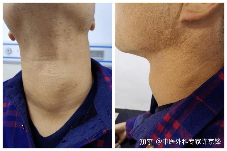 地方性甲状腺肿有哪些临床表现 ? - 知乎