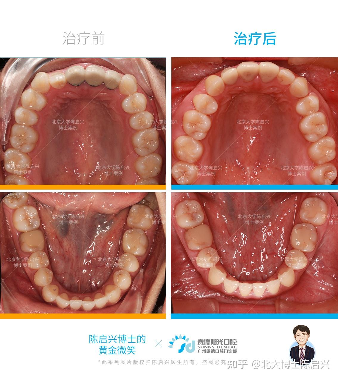 牙性地包天矫正过程图图片