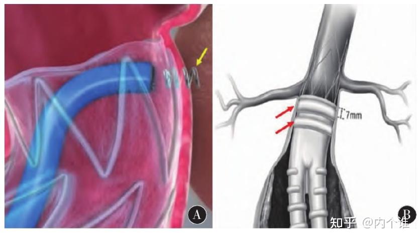 主动脉覆膜支架图片图片