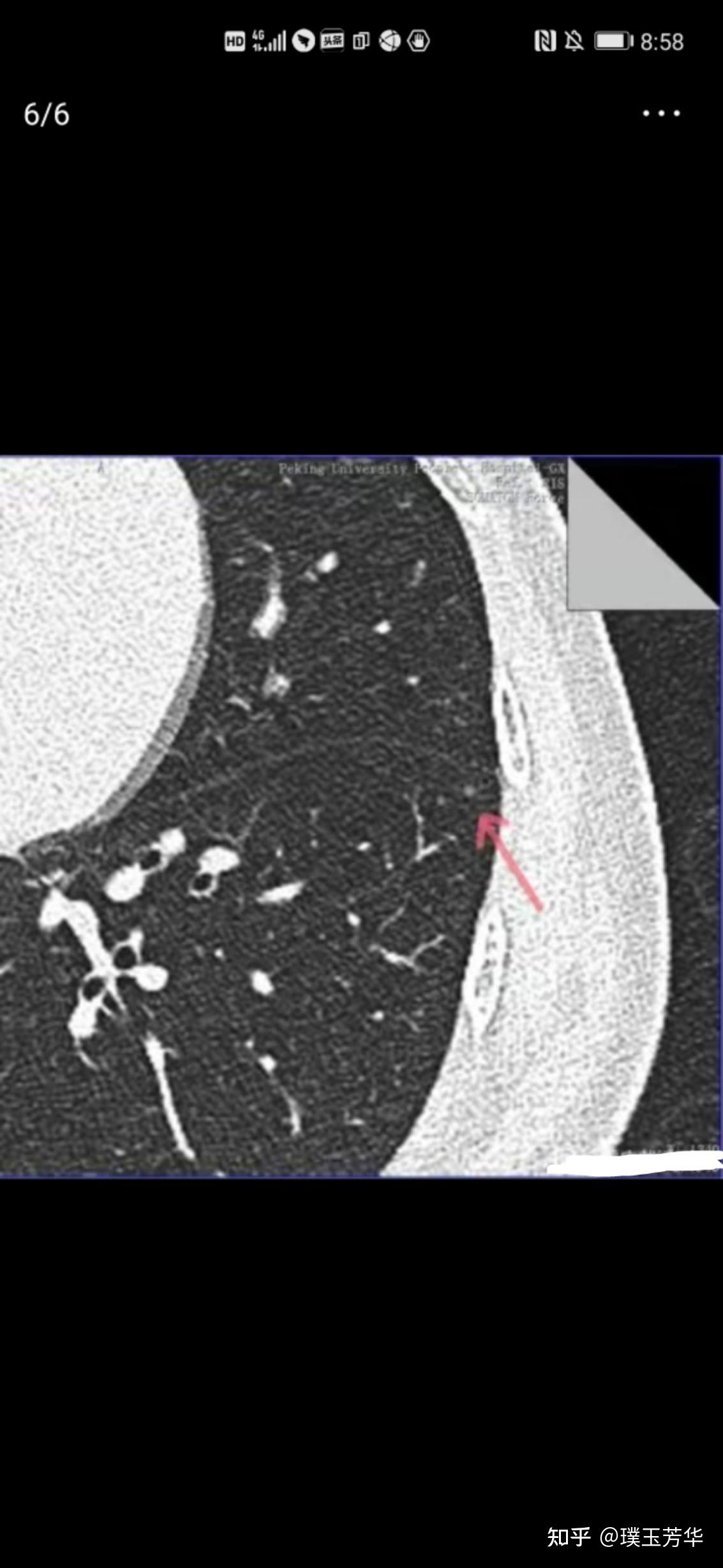 3mm肺结节让北京患者焦急寻医我回复其实随访都不用