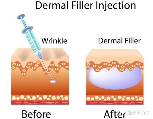 丽舒妥dysport)的双相玻尿酸瑞兰(restylane)和美国allergan公司(大名