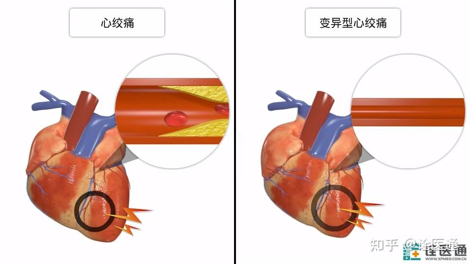 导致的其他类型心绞痛不同,变异型心绞痛是由于冠状动脉痉挛性收缩