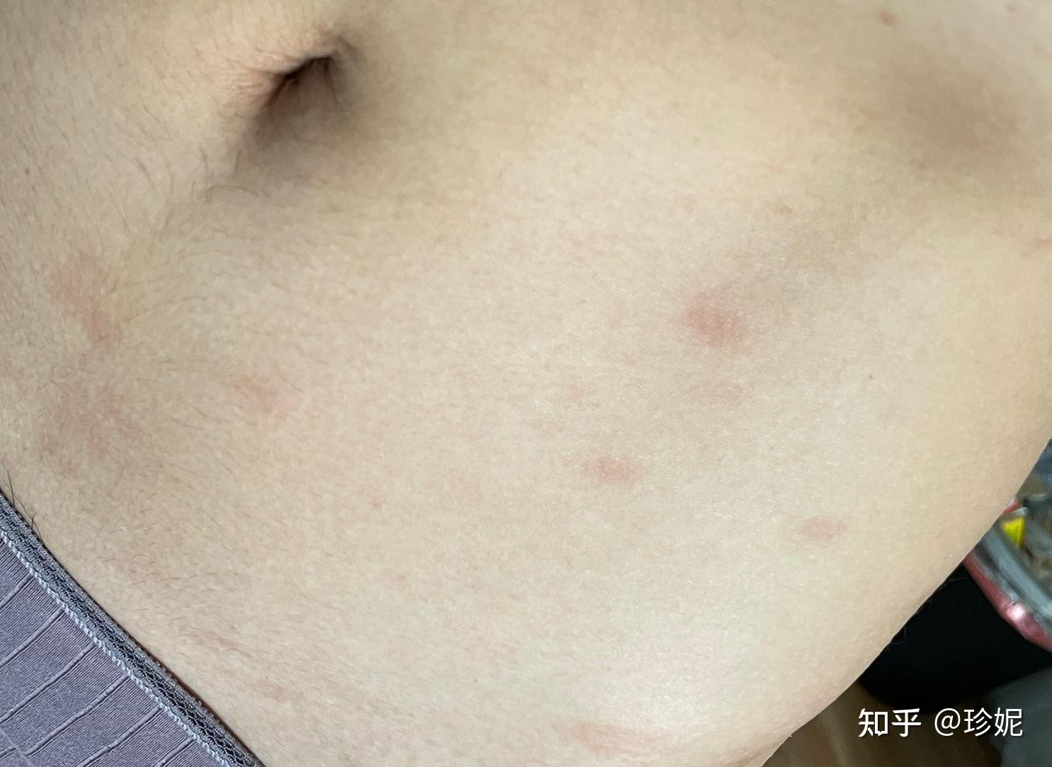 被玫瑰糠疹折磨的第24天 - 知乎