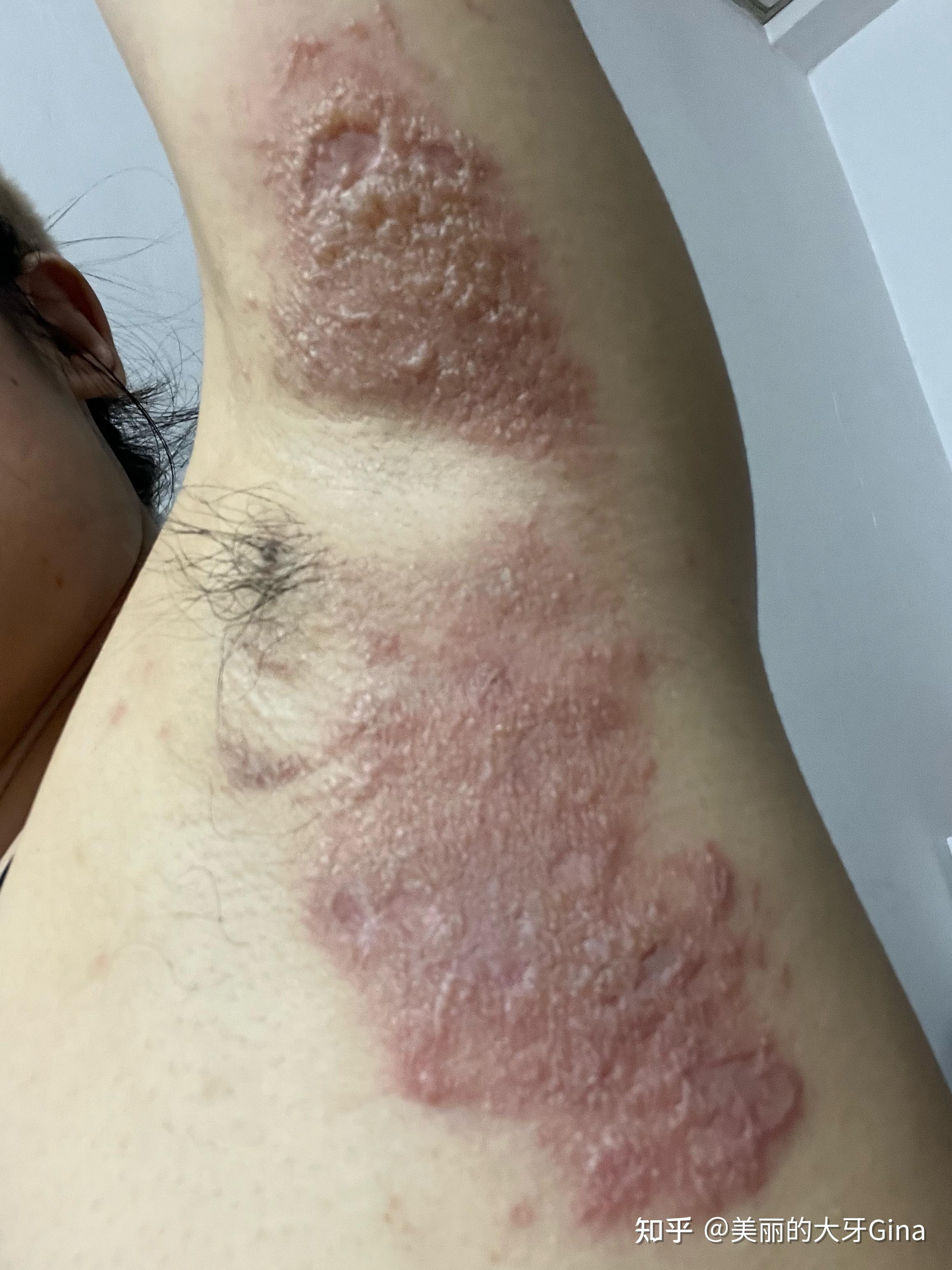 被隐翅虫爬了记录全过程