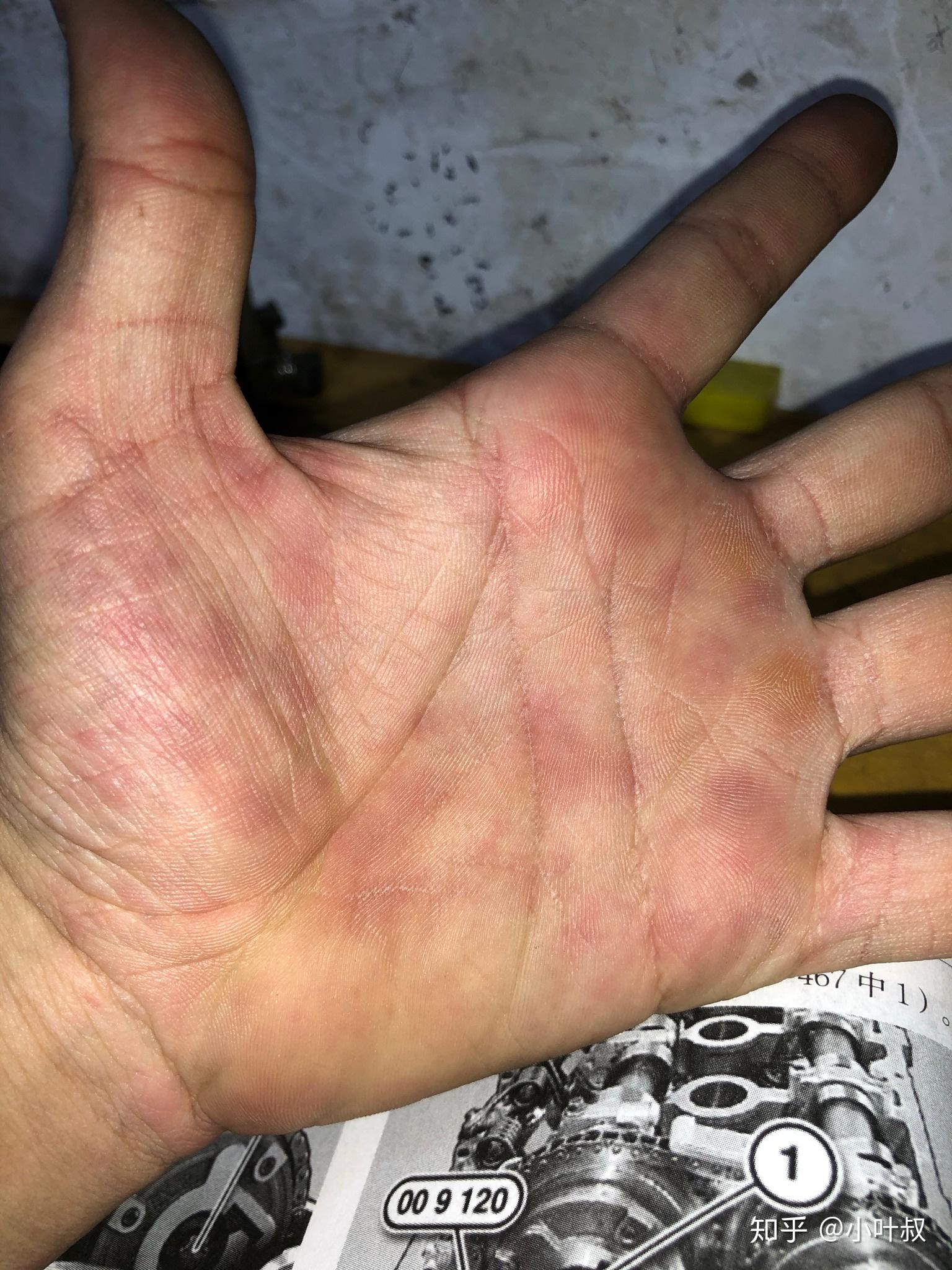 手上出现红斑红疹是什么问题? - 知乎