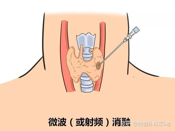 甲状腺癌手术根治后还会出现转移 转移后会威胁生命 怎么治疗 知乎