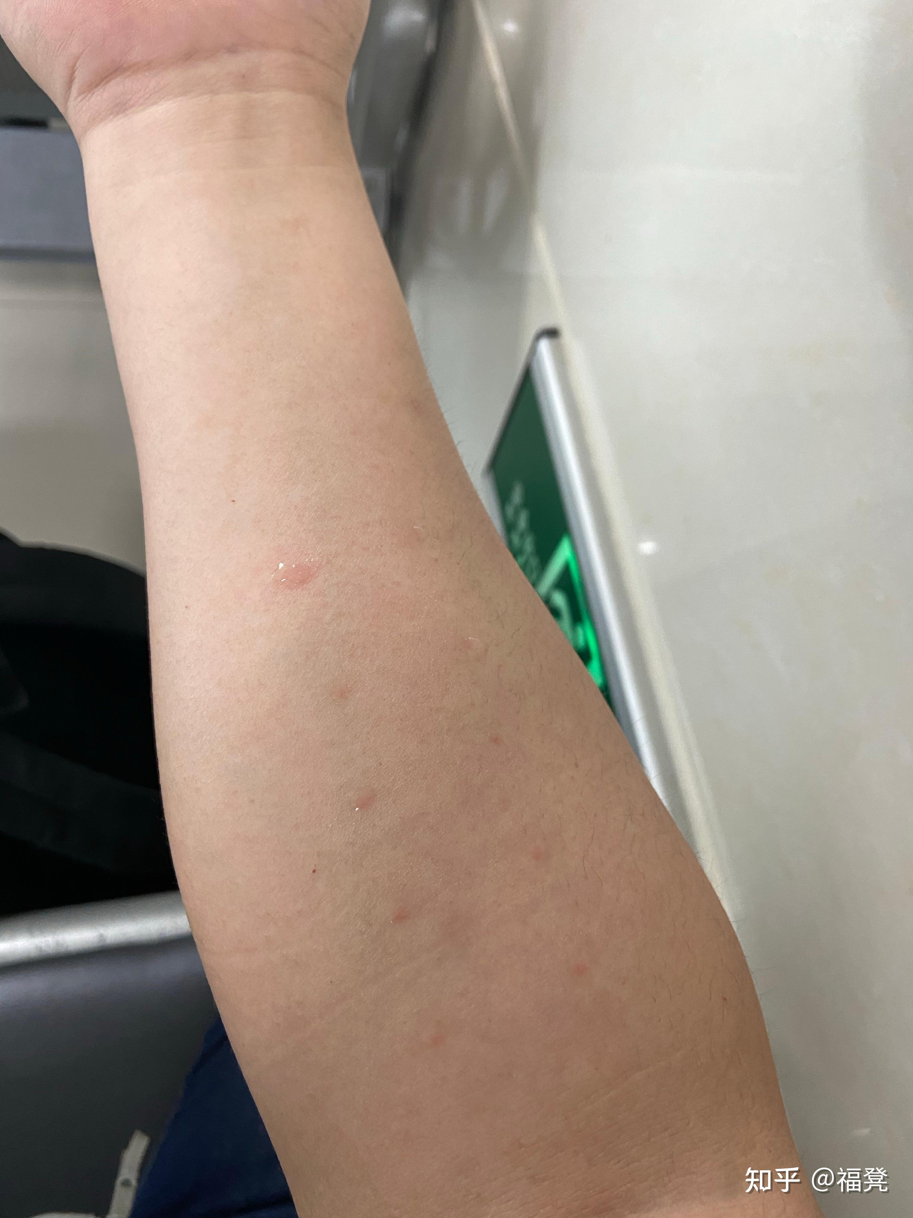 脱敏治疗,从此摆脱氯雷他定星人称号