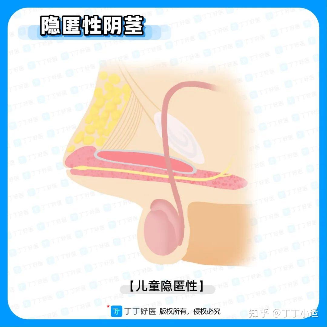 消失的丁丁,隐匿性阴茎的分型和治疗