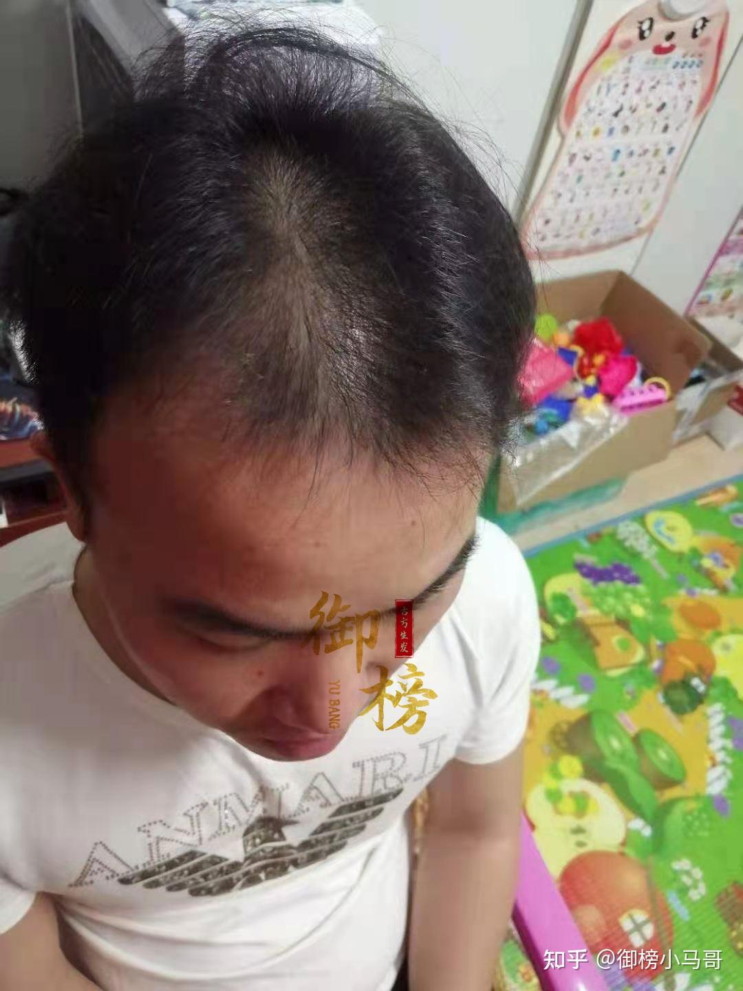 生发日记长期更新5年脂溢性脱发还有救吗