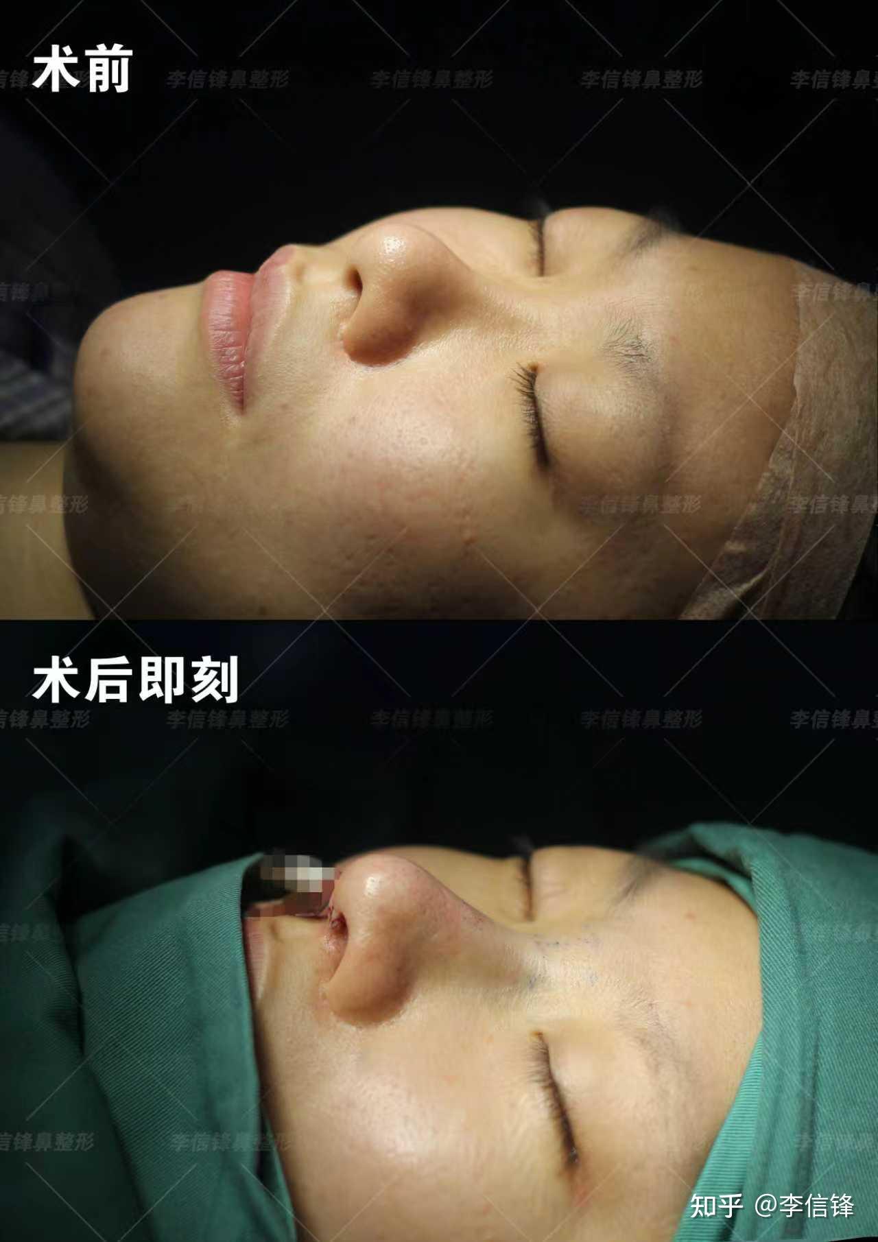 初鼻鼻综合-塌鼻梁、大鼻头改善案例,术后即刻对比~ - 知乎
