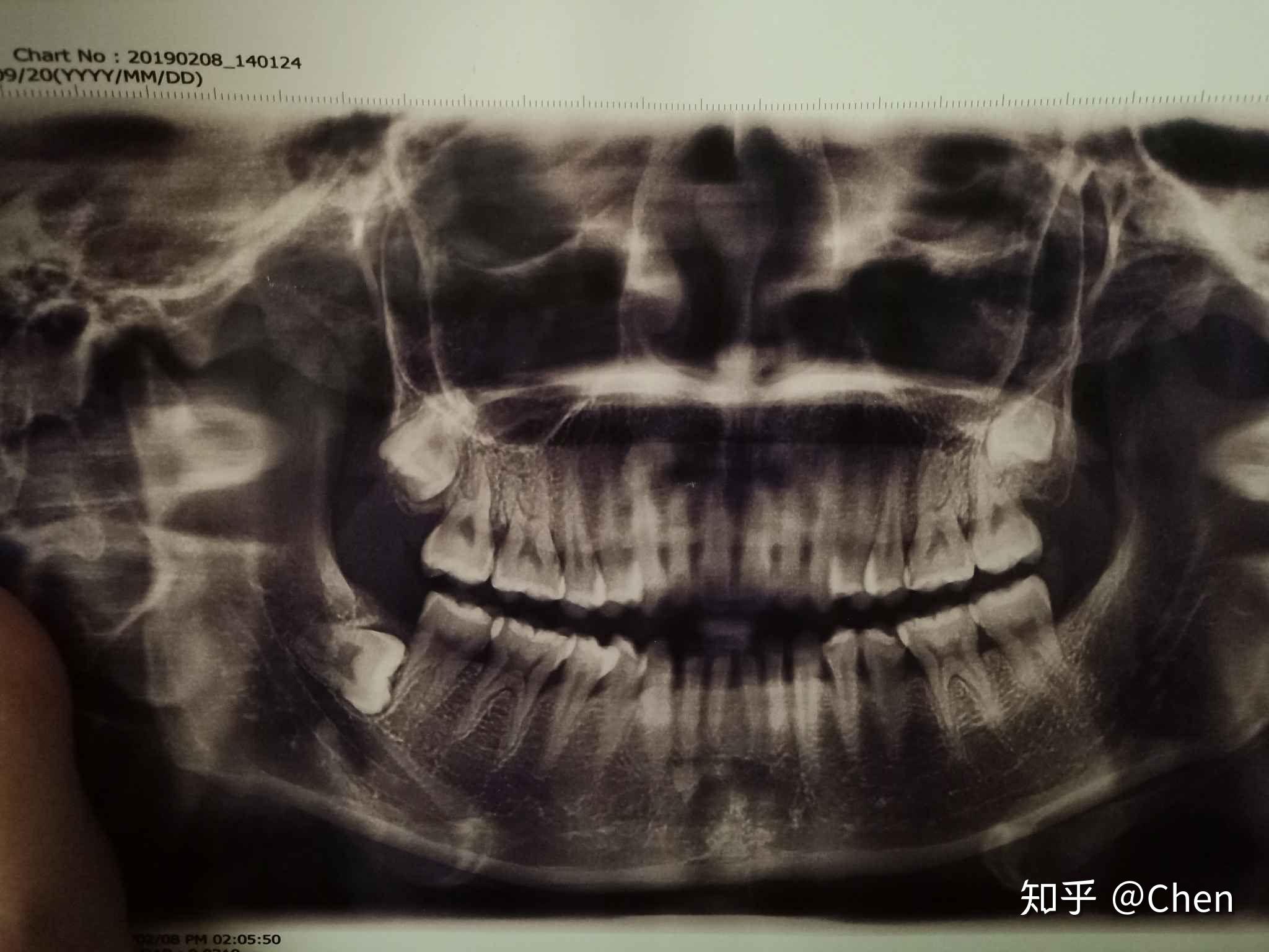 拔智齿矫正凸嘴可以吗?