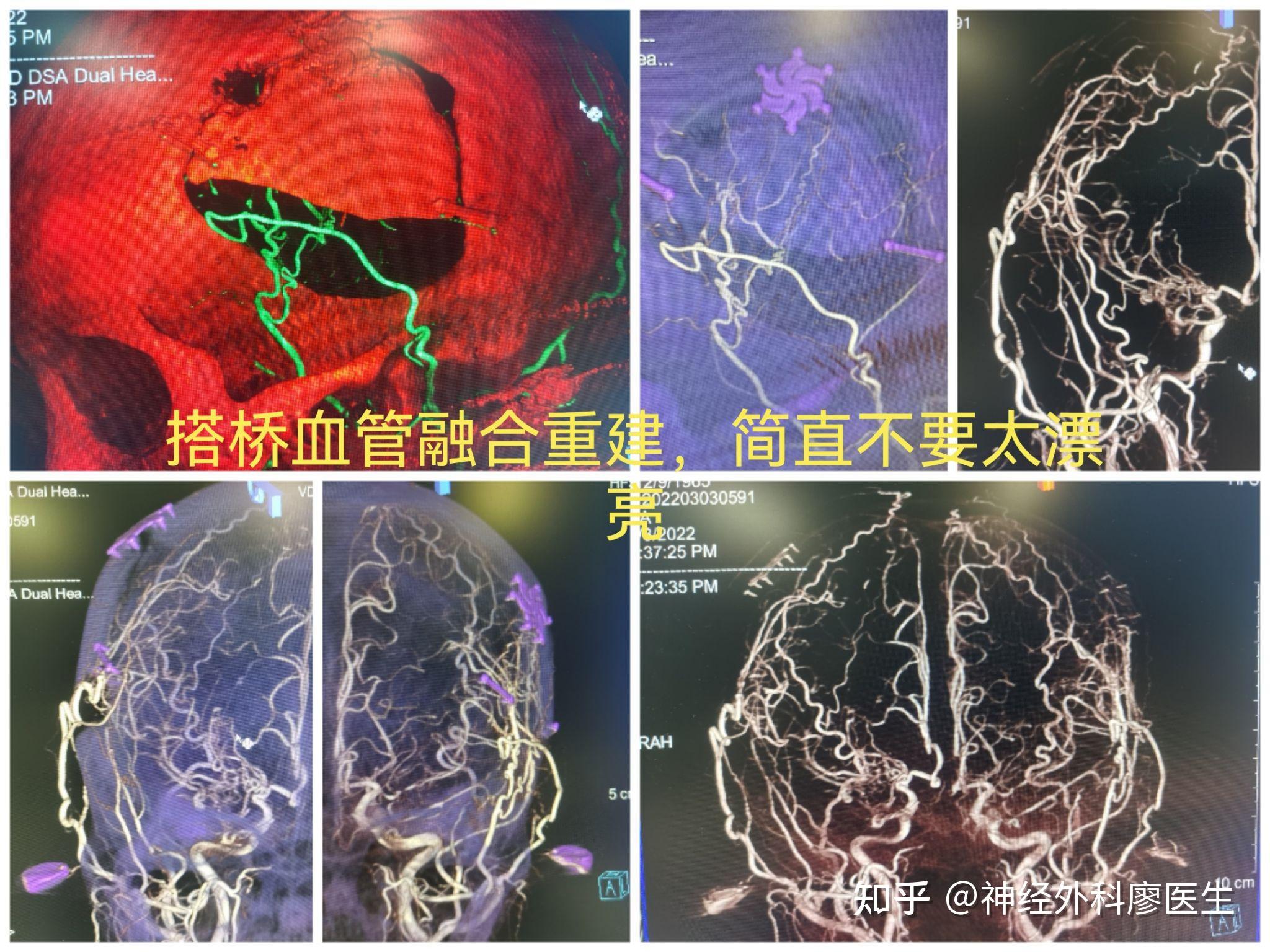 煙霧病搭橋術後複查造影融合後的藝術品