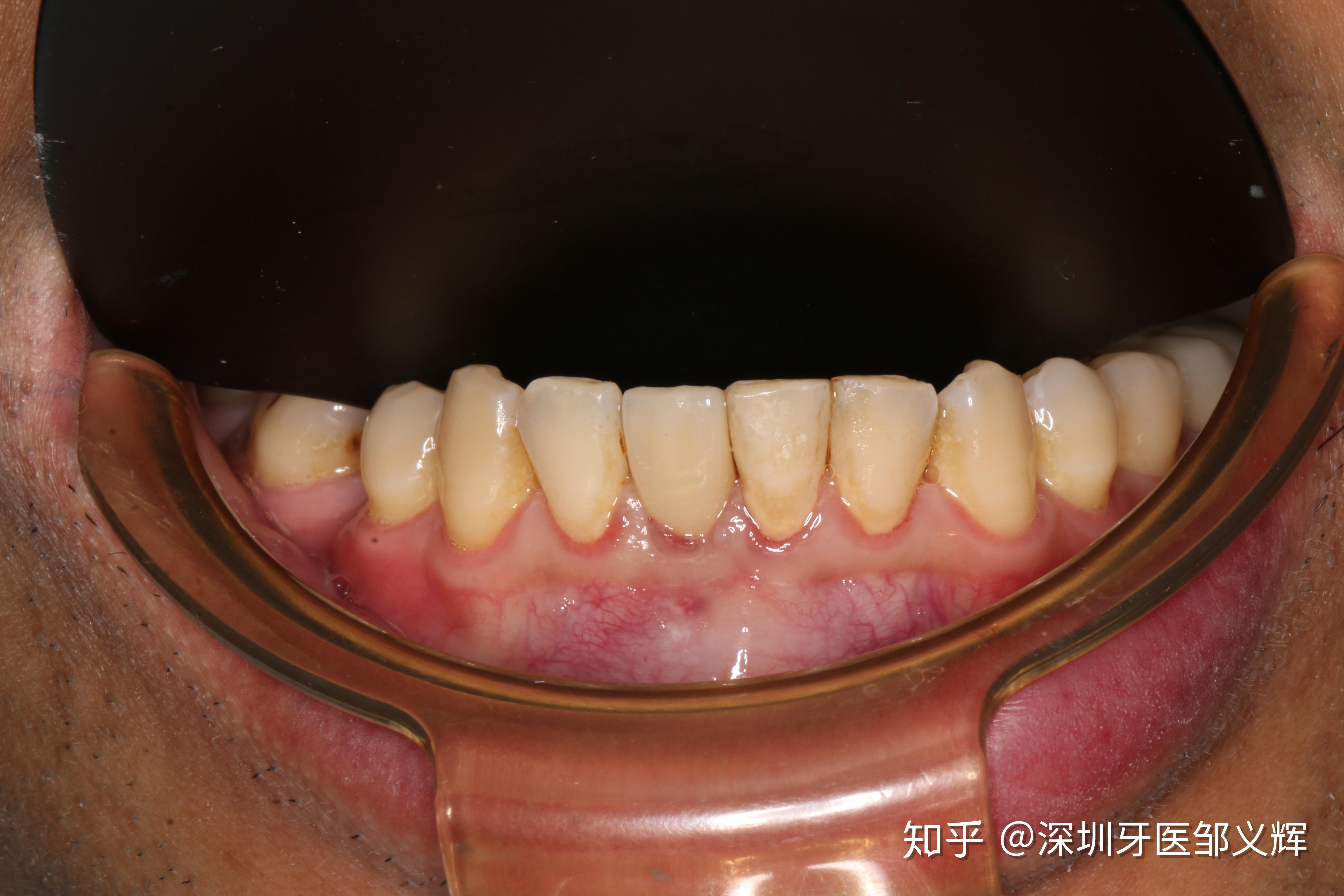 下前牙种植修复一例 - 知乎