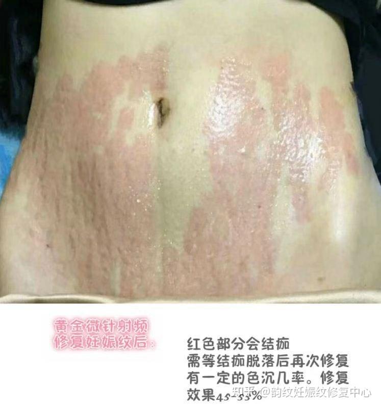 产后妊娠纹修复有哪些修复方式?效果怎么样?好不好? - 知乎