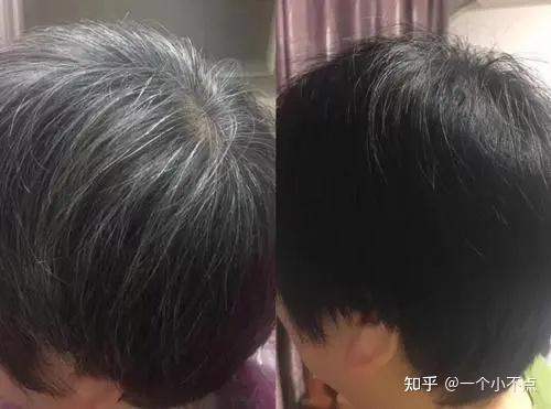 白头发是怎么引起的说明体内缺少这几个元素这样调理才能慢慢变黑