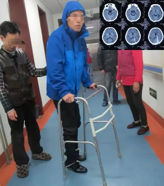男子脑积水分流术3年后发生堵管木僵缄默运动不能综合症经脑脊液科