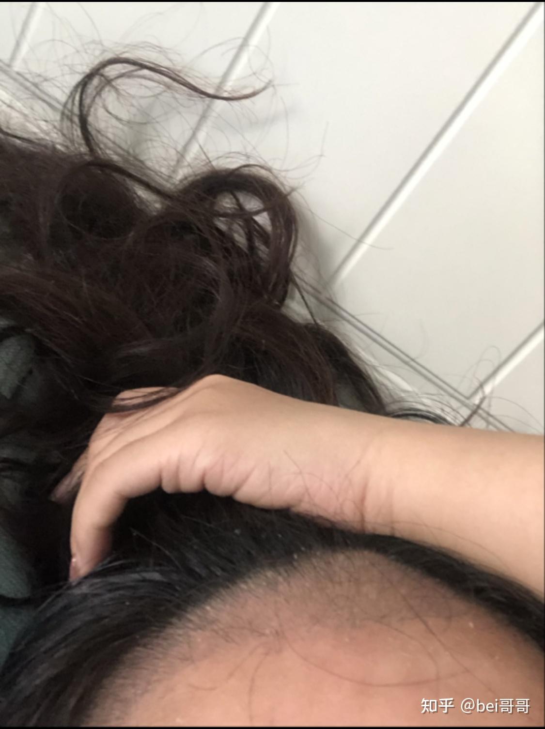 小绒毛剃了植发(小绒毛剃了会变粗吗)