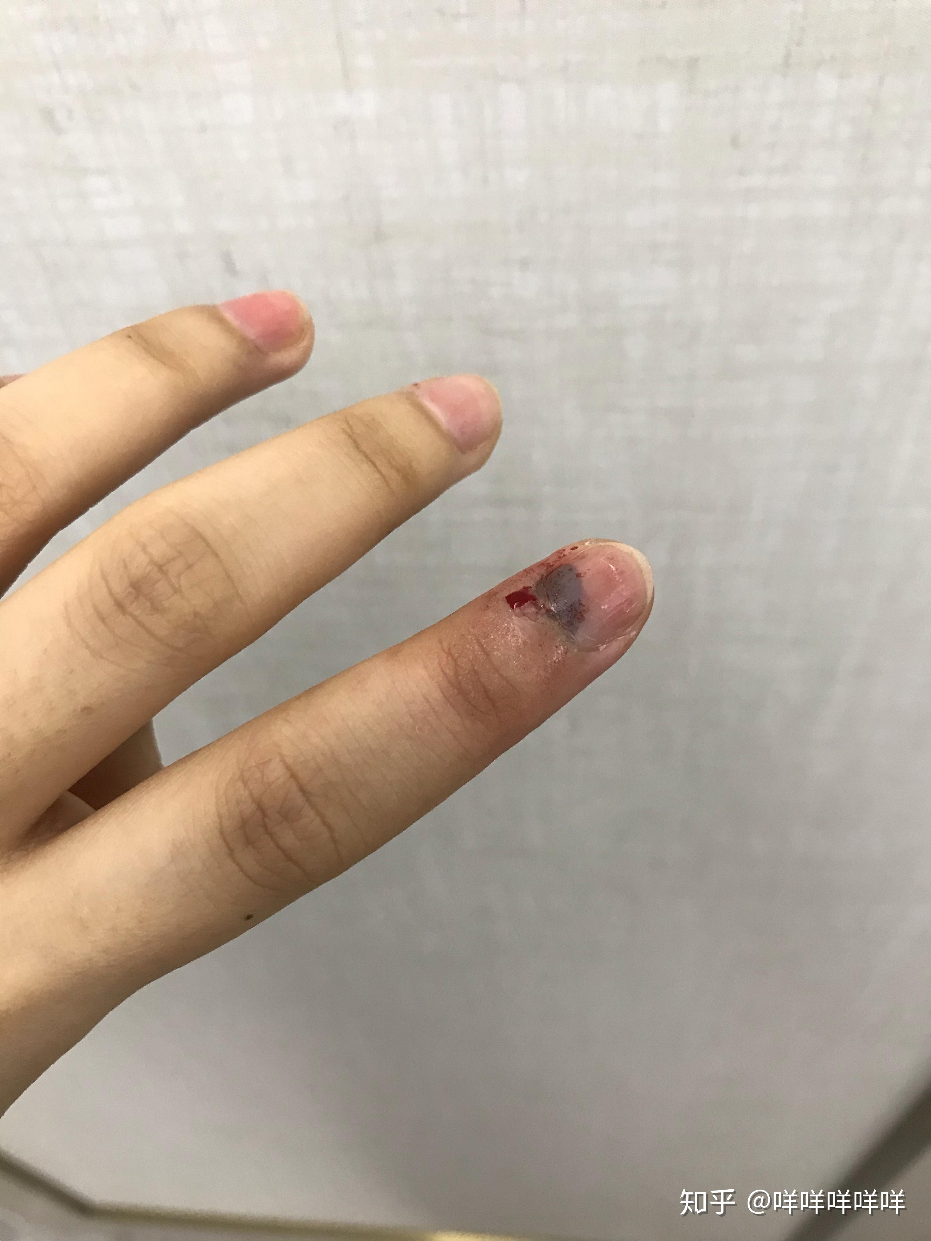 手指被门夹到飙泪是种怎样的体验?