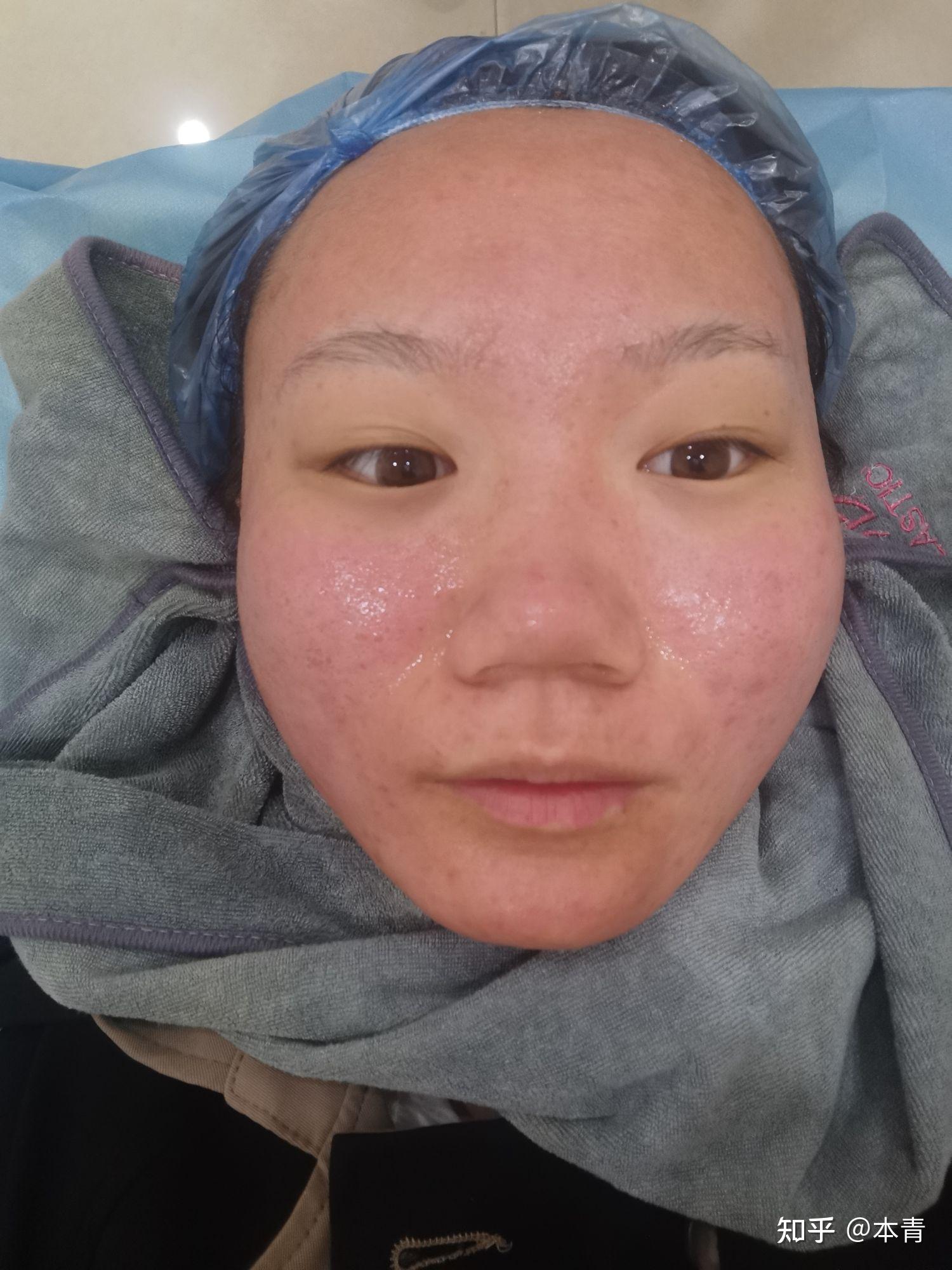 记录医美伊肤泉微针效果