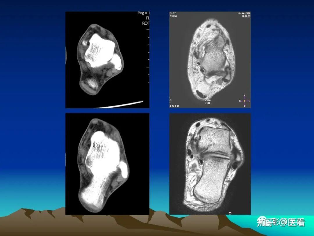 脚踝韧带损伤ct图片图片
