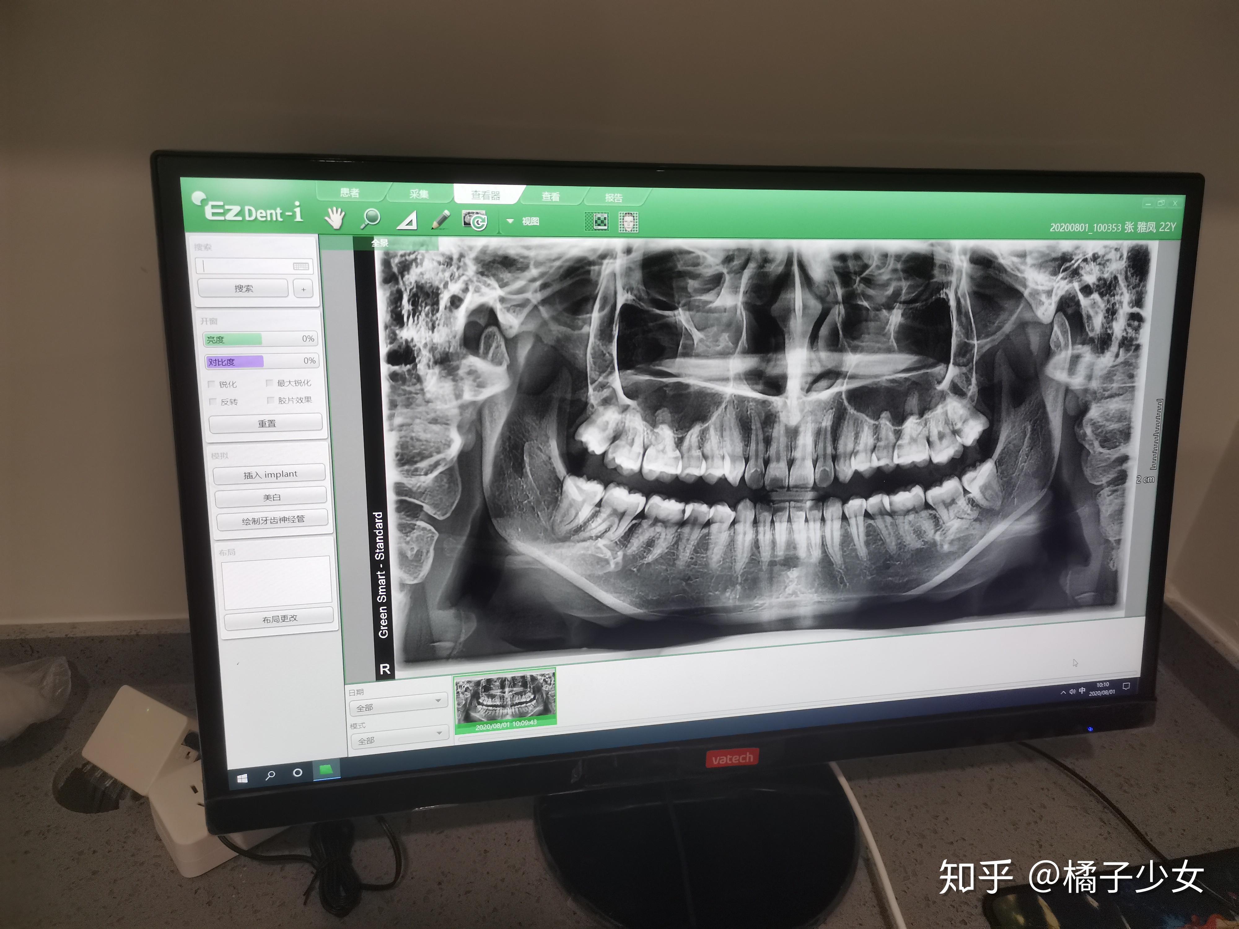 邊還有一個小洞,是智齒露的角往腮邊紮了 巨疼…本來是想去拍個全景