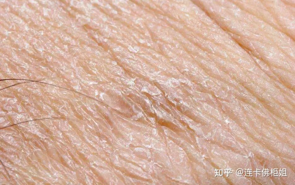 秋冬皮肤干燥,爆炸起皮,还红敏刺痛该怎么办? - 知乎