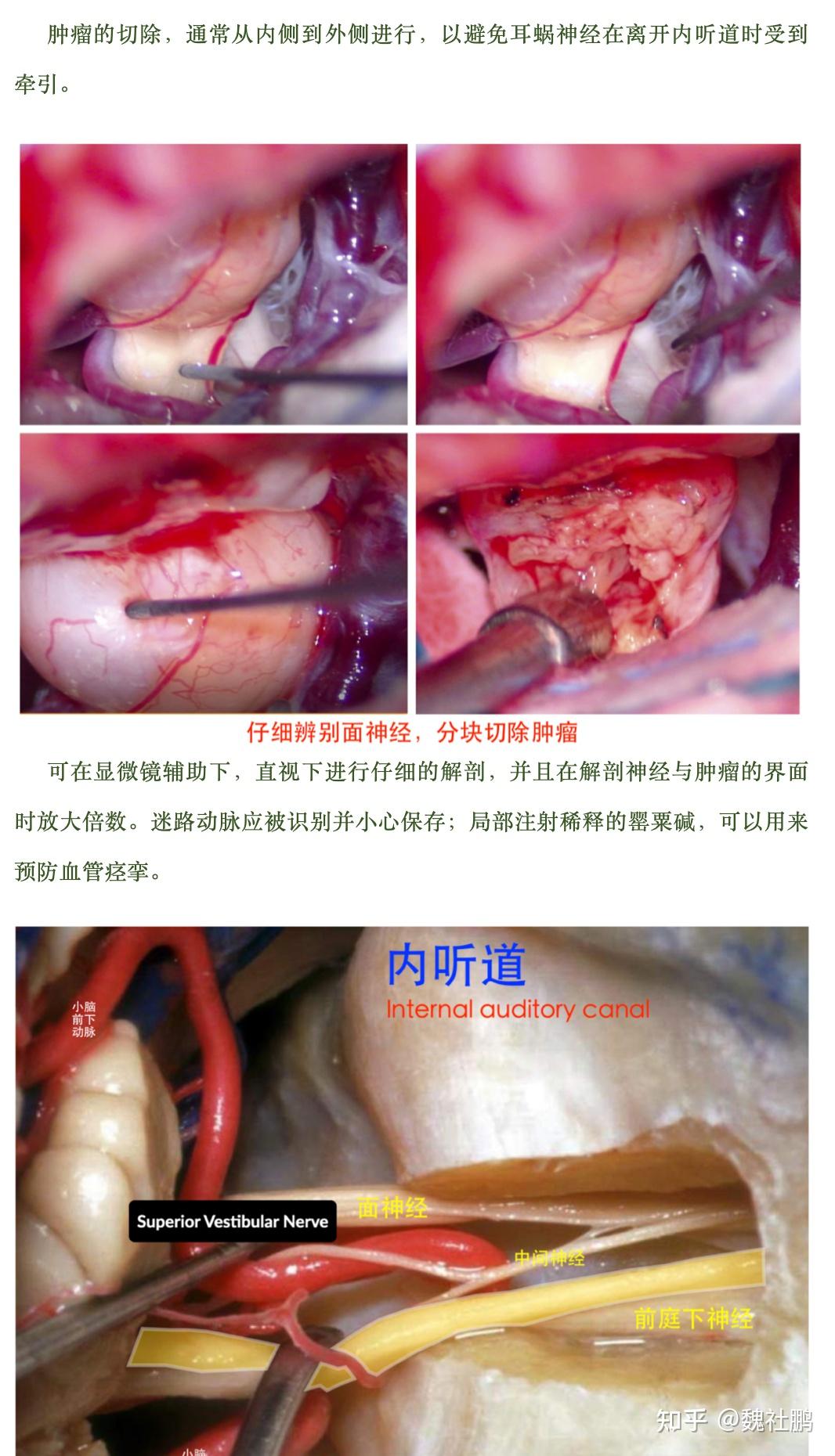 枕下乙状窦后手术入路治疗听神经瘤