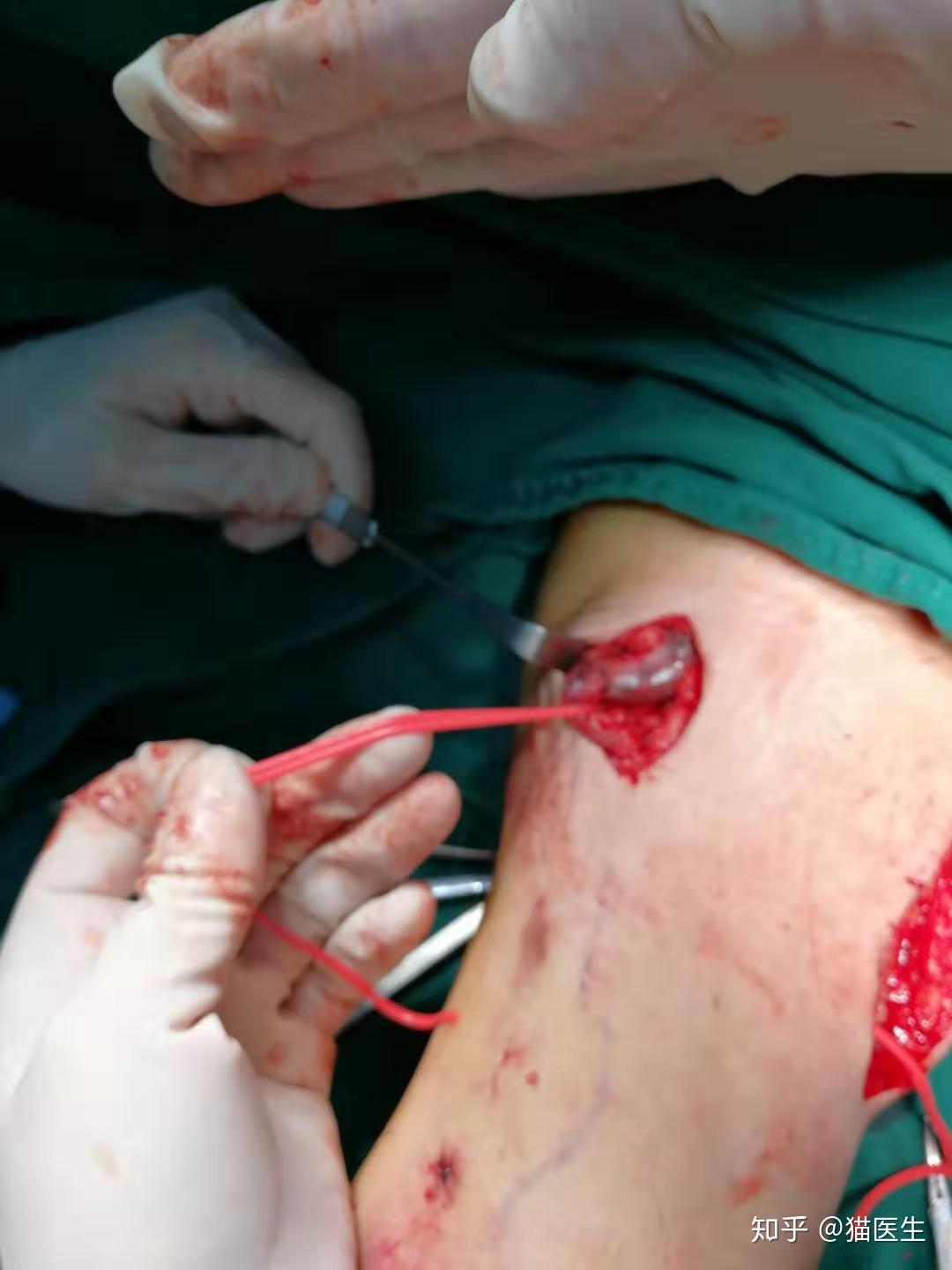 优化设计方案治疗头静脉弓狭窄闭塞