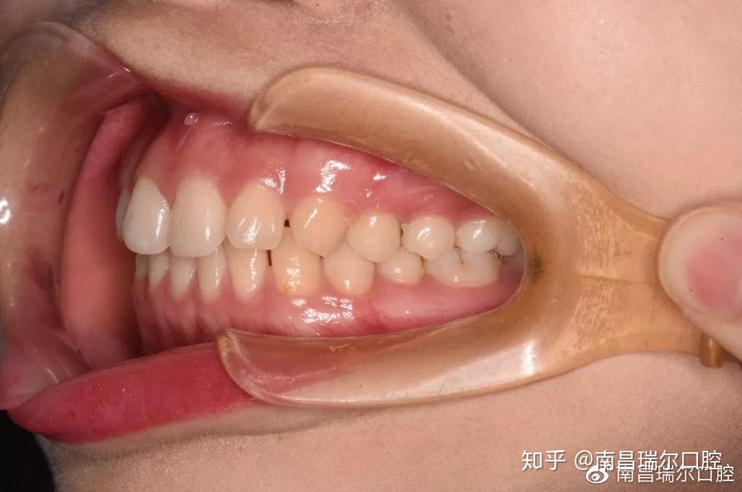 病例报告第3期门牙缝大漏财还毁颜值牙医如何逆天改命快速关缝纳财