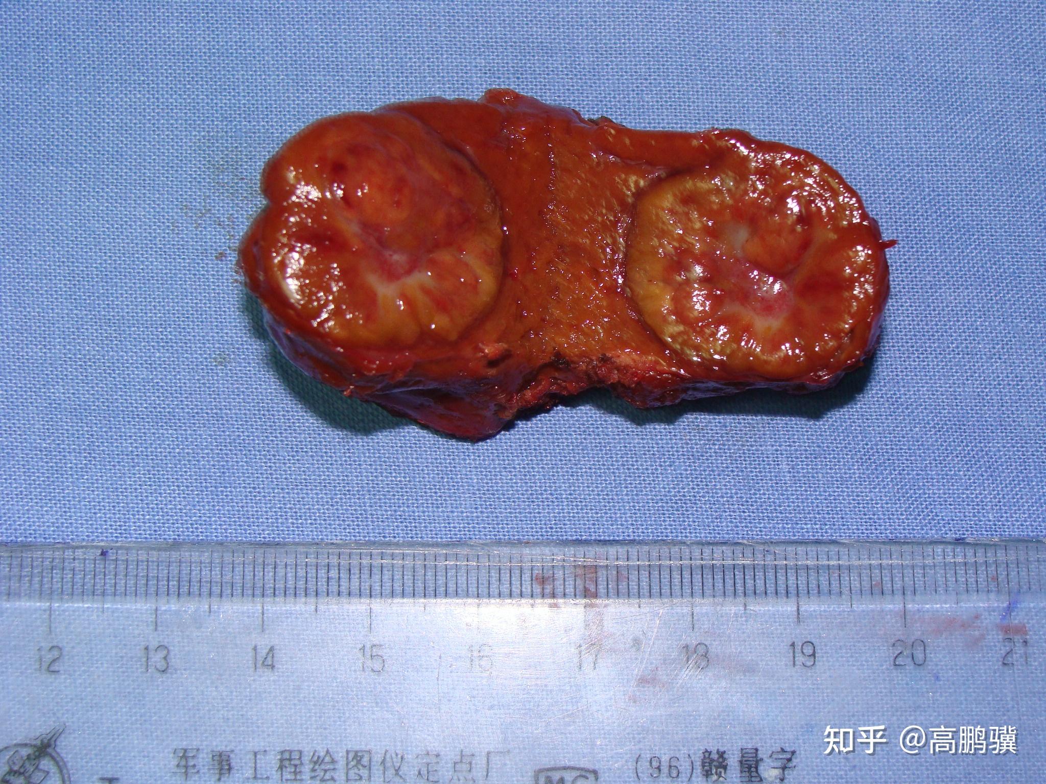 小结节性肝硬化图片