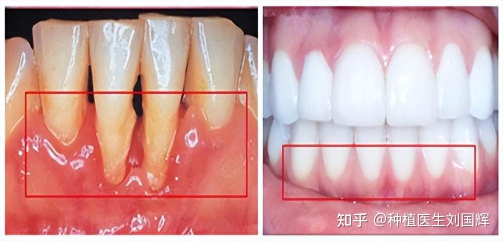 牙根外露怎么办图片