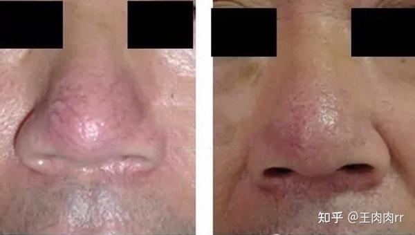 酒糟鼻引起的"大鼻子"怎么处理呢?