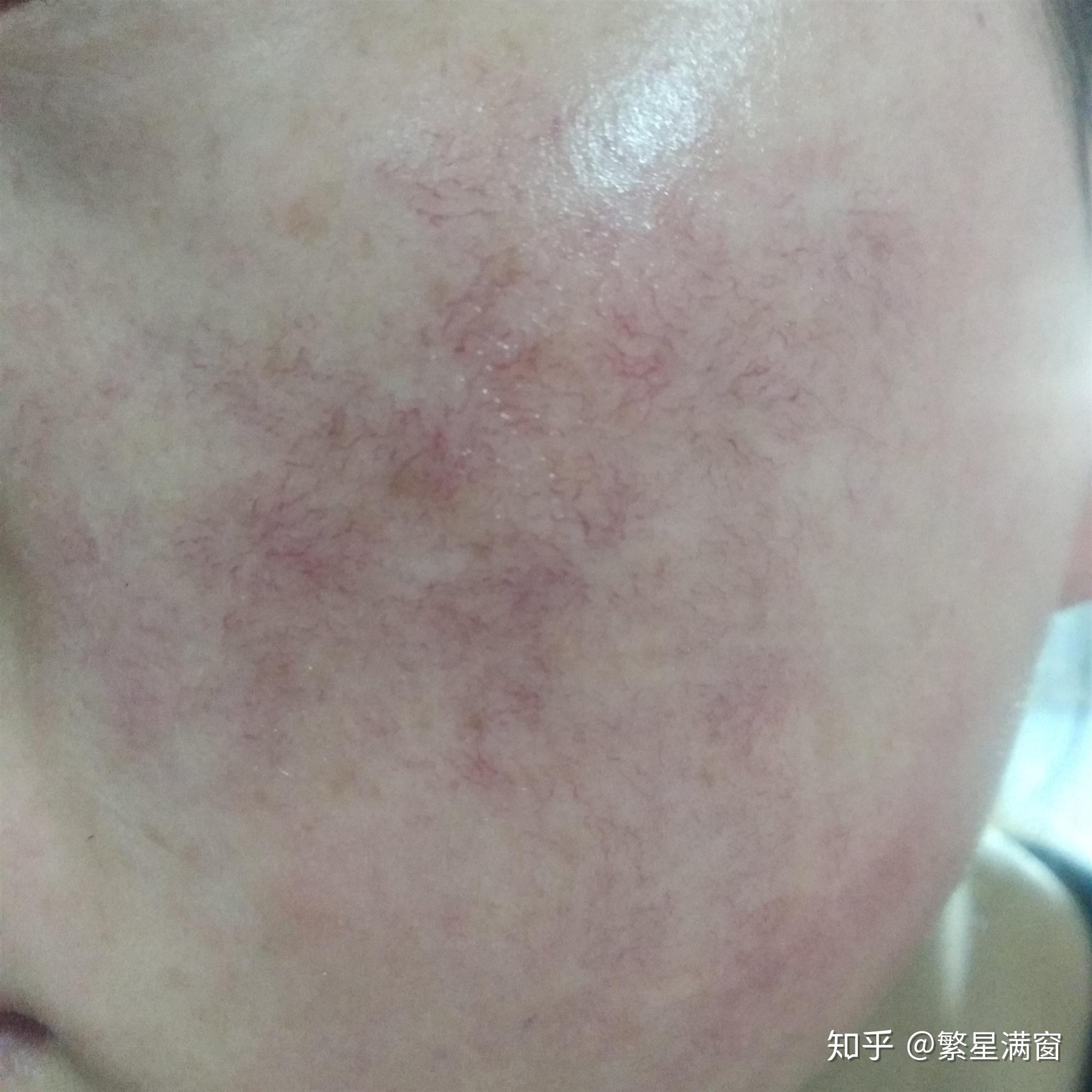 什么称为敏感肌 v2-1925895c482cda1b9cd2d738bf7ddbf5_r.jpg
