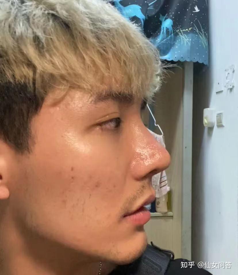 男生肋骨鼻综合面诊经历面诊经验术前准备巨详细流程分享文字有点多