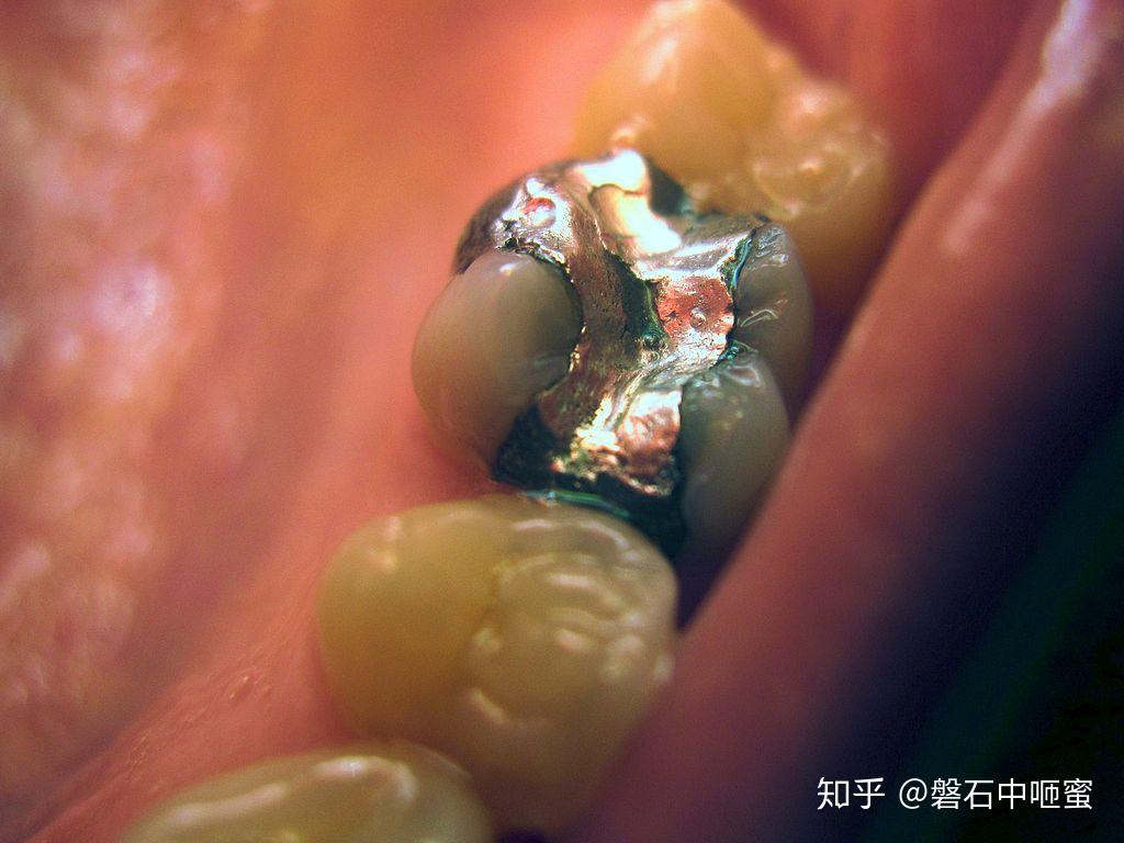 位于邻面的牙颈部龋已经是深龋了，患者以为是色素沉着。 - 知乎