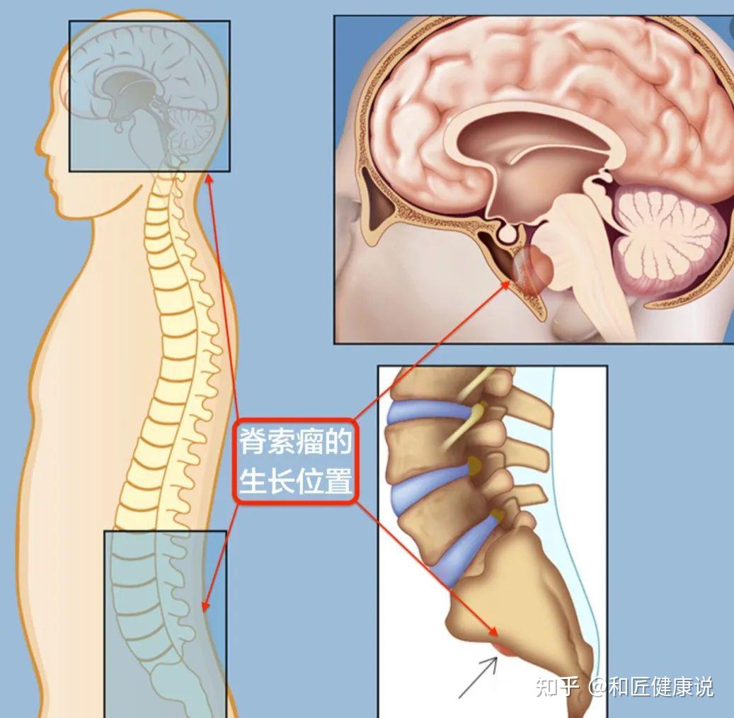 脊索瘤图片及讲解图片