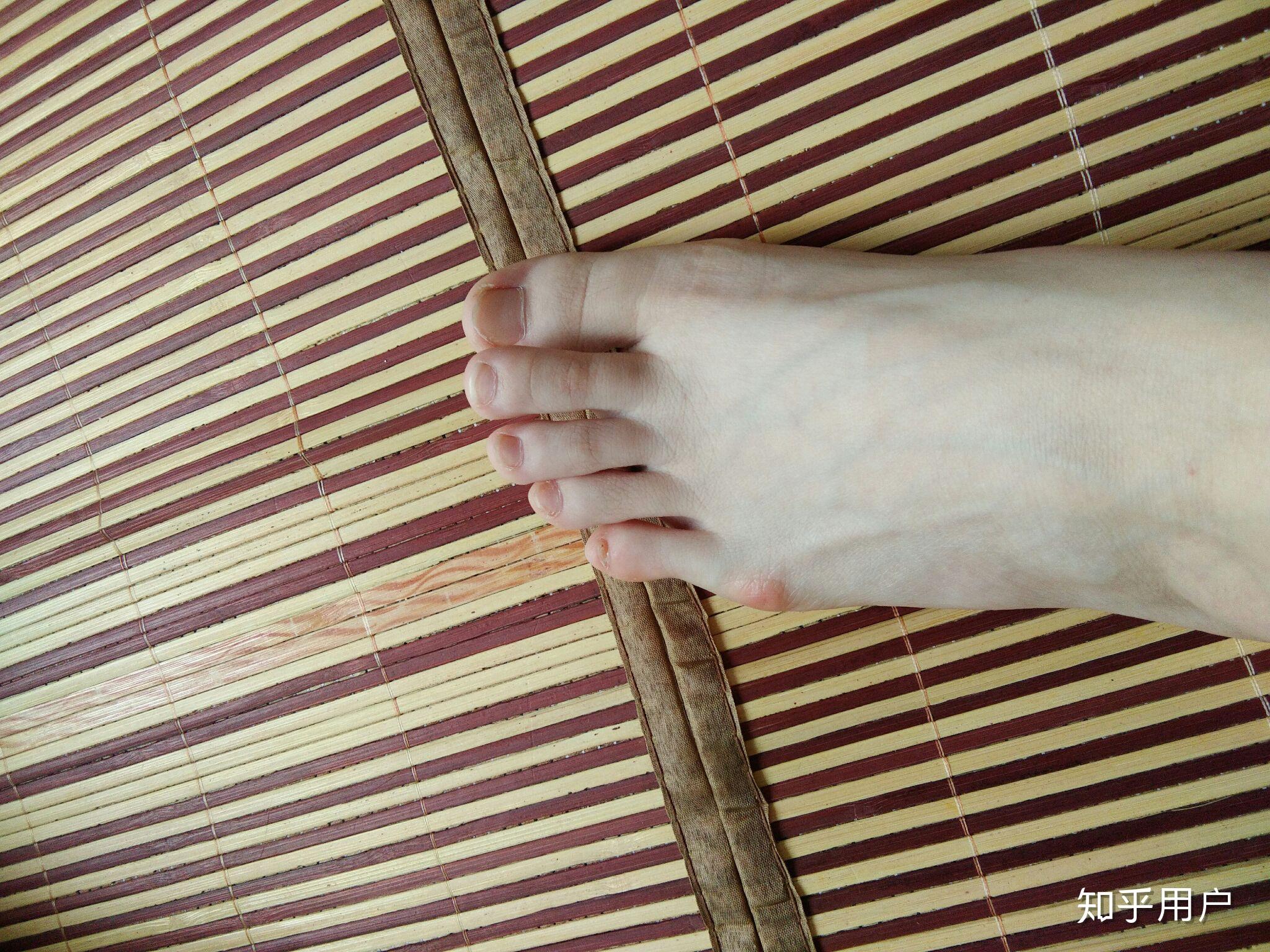 女生脚趾拇外翻是什么样体验