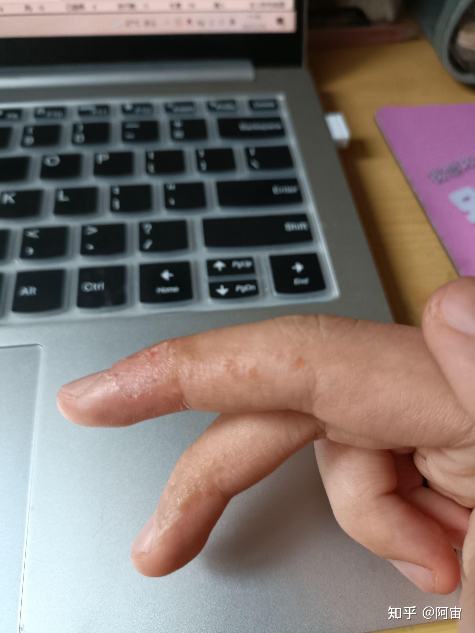 记录一次汗疱疹的痊愈过程