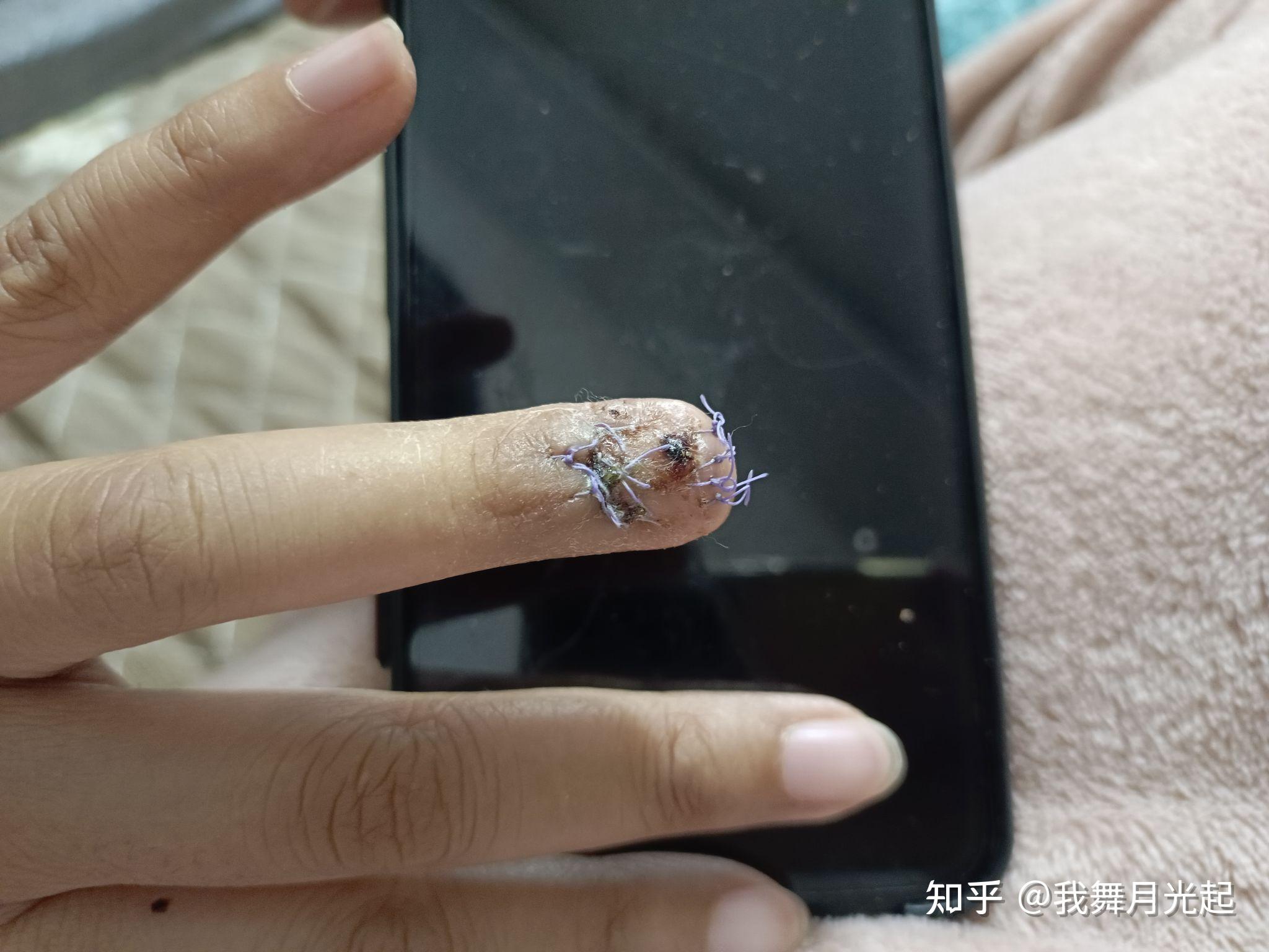 甲下血管球瘤,折磨我十多年的小恶魔.