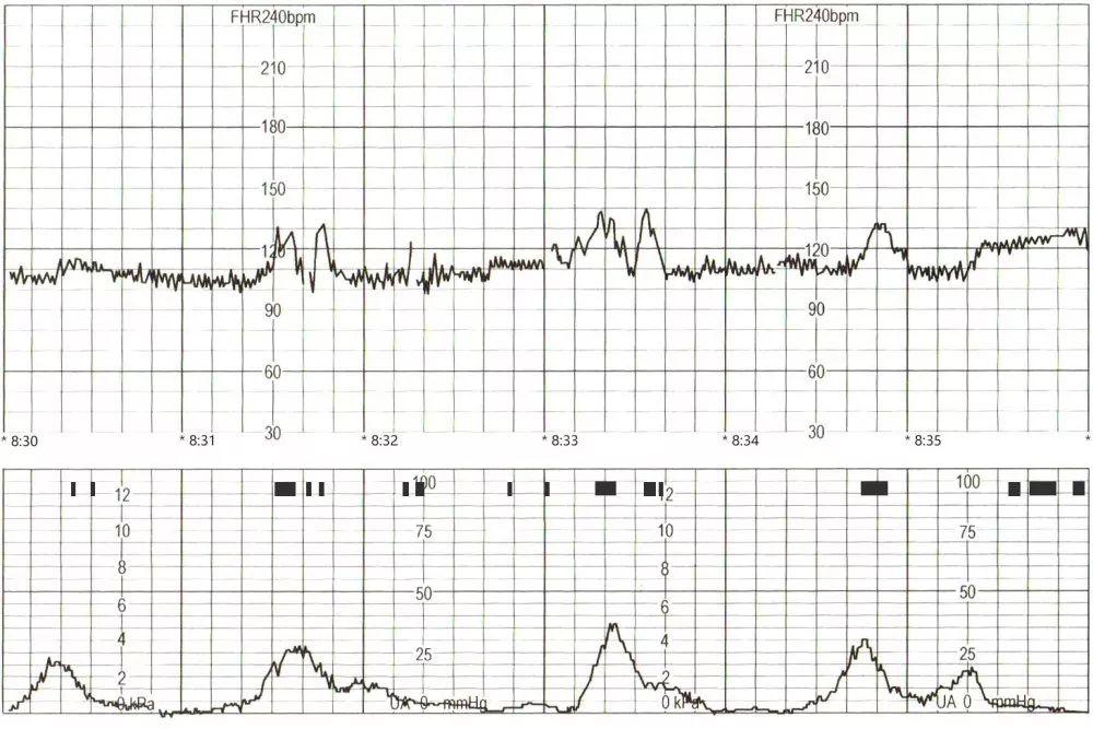 临产前宫缩图胎监图图片