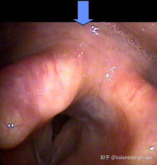 食管返流食道反流 食管返流食道反流