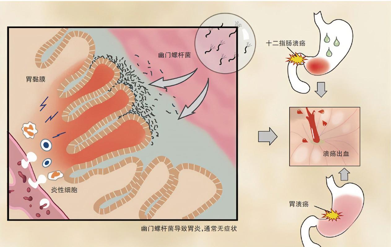 糜烂性胃炎伴幽门螺旋杆菌感染-京东健康