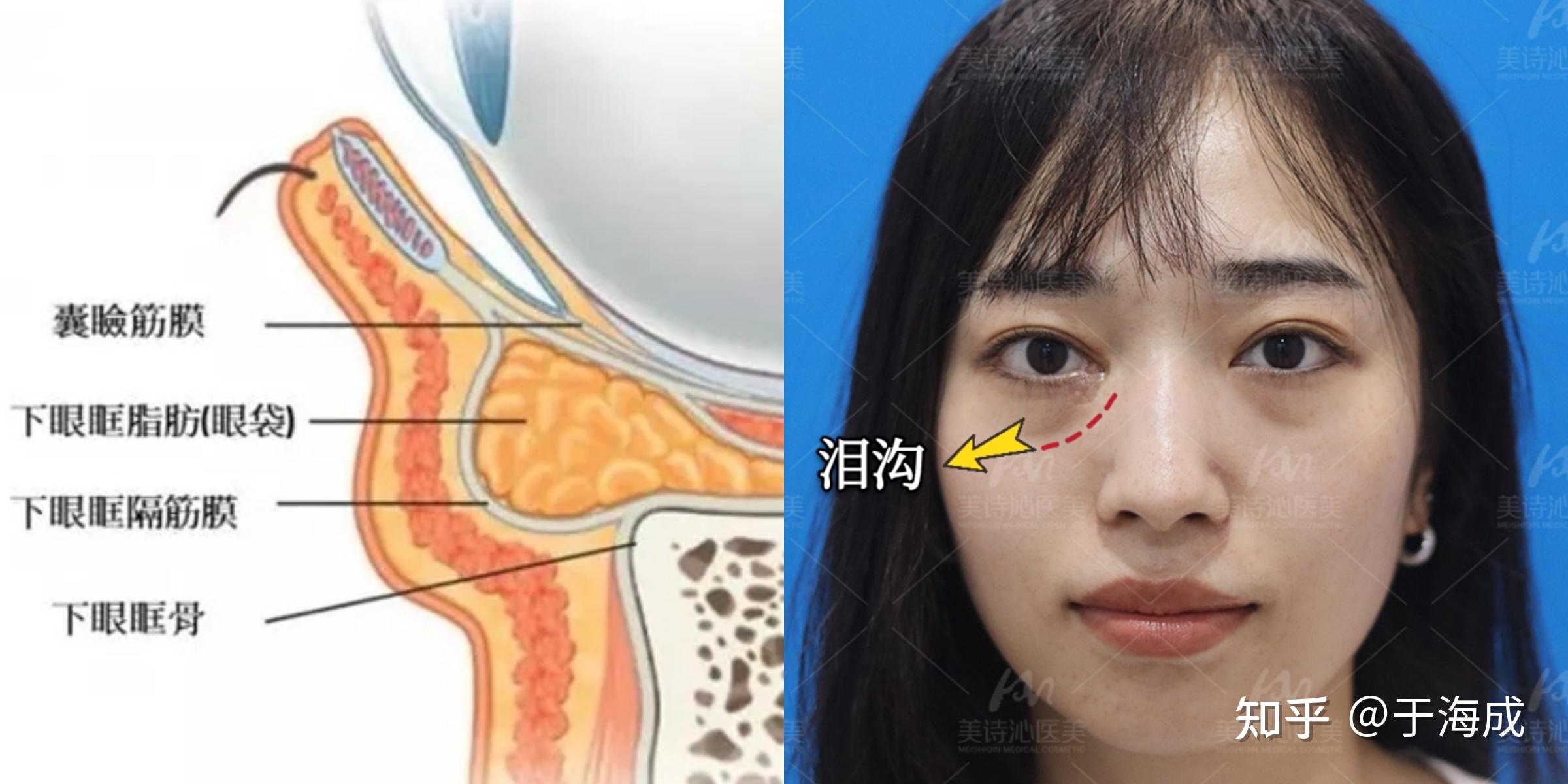 拿掉滤镜，一样的年龄，不一样的泪沟！ - 知乎