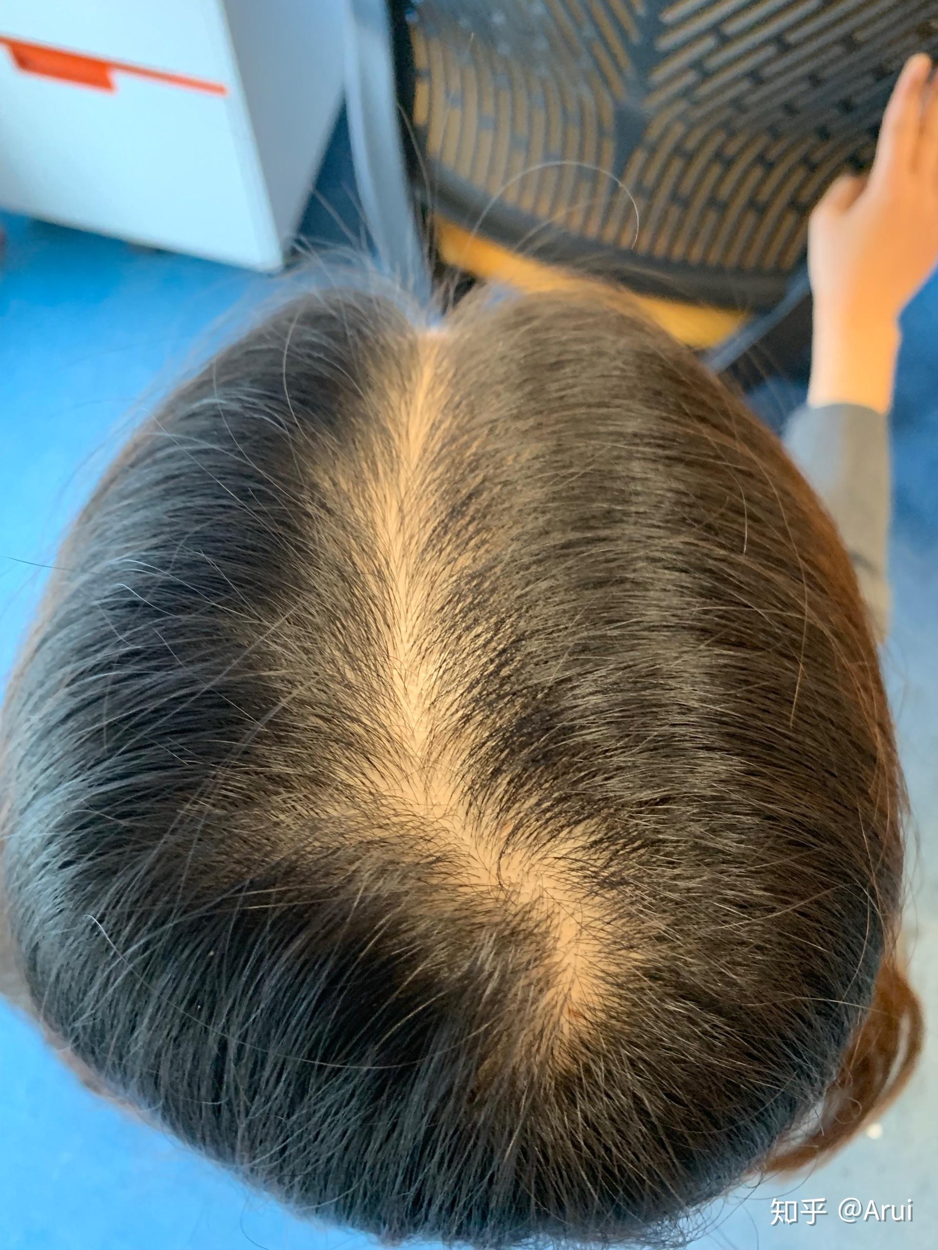 女生头顶头发少是什么体验