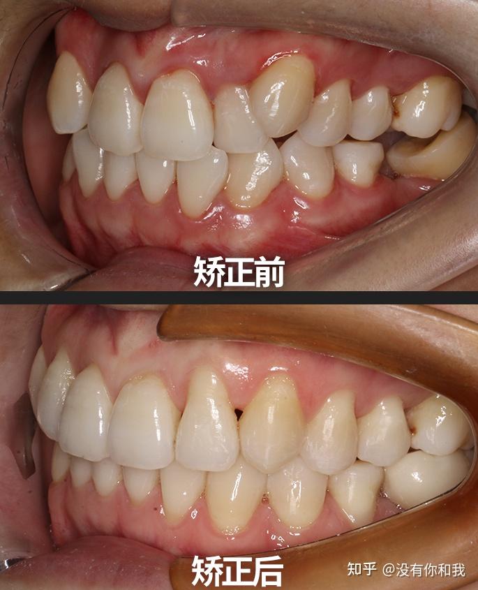 如果说有什么事情是做了一定不后悔的,那一定是牙齿矫正!